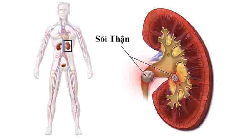 Hạt chuối hột chữa sỏi thận có hiệu quả không?