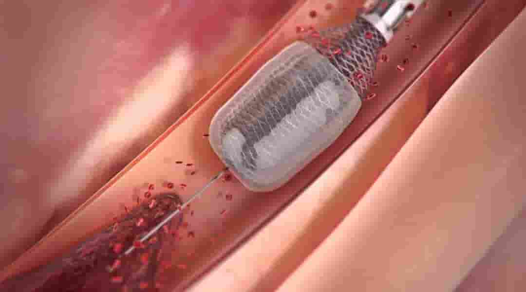 bác sĩ cũng có thể lựa chọn một loại thrombolysis (điều trị tan huyết khối) khác được gọi là loại bỏ huyết khối bằng dụng cụ cơ học.